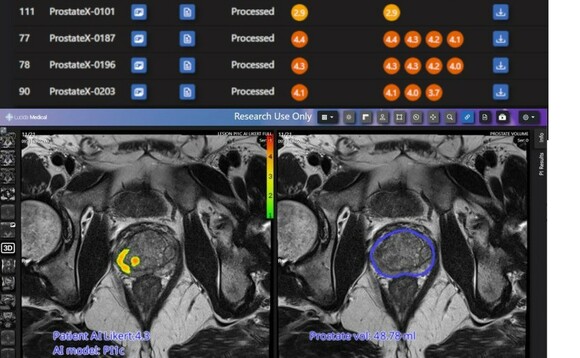 Ai tool for prostate cancer diagnosis lucida medical 580x358.jpg