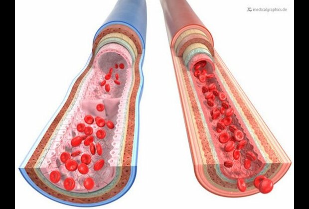 Revascularisation procedures helping U.S. veterans avoid amputation