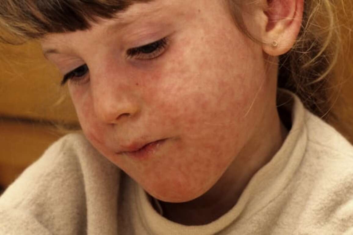 Province warns of new measles exposure sites in southwestern Manitoba
