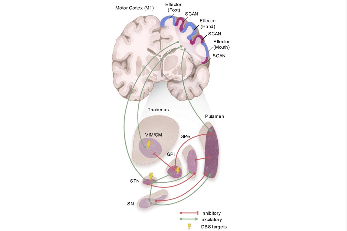 Chinese scientists identify core brain network underlying Parkinson's disease, enabling better treatment