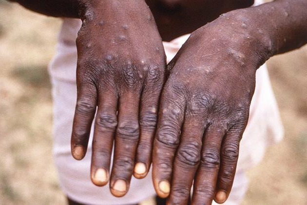 Minimal risk of monkeypox transmission in UK following confirmed case