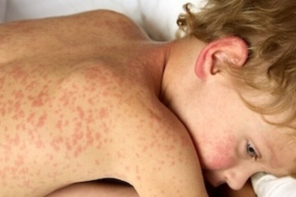 IN schools head to spring break amid rising measles concerns
