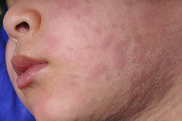 Illinois health officials confirm two measles cases in Cook County