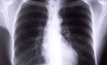 NIOSH offers free black lung screenings