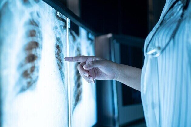 Scientists identify main driver of early-stage lung cancer development