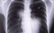 Black lung could cost coal miners their social licence
