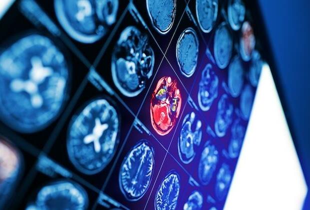 AI could improve outcomes for survivors of stroke