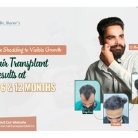 From Shedding to Visible Growth: Hair Transplant Results at 3, 6 and 12 Months