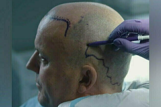 Top 20 Best Hair Transplants in Turkey and Hair Transplant Costs