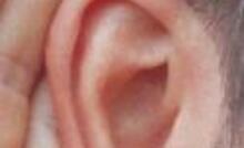 Relief offered for hearing loss