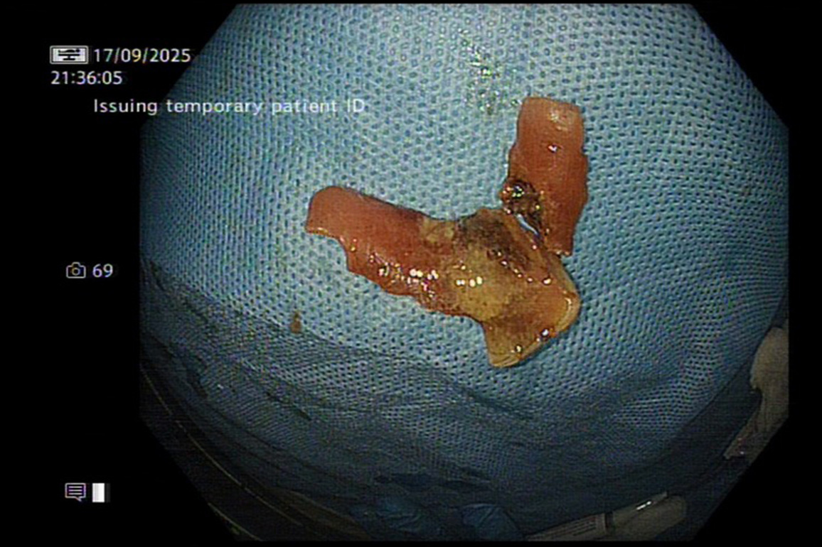 Laser to the rescue: Delhi doctors vaporise stuck denture to save patient from major surgery