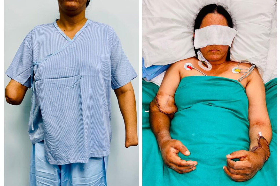 Hand Transplant gives new life to young mother who lost both hands in chaff-cutting machine accident