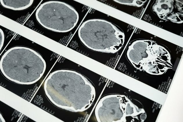 Researchers find new approach for treatment of devastating brain tumours