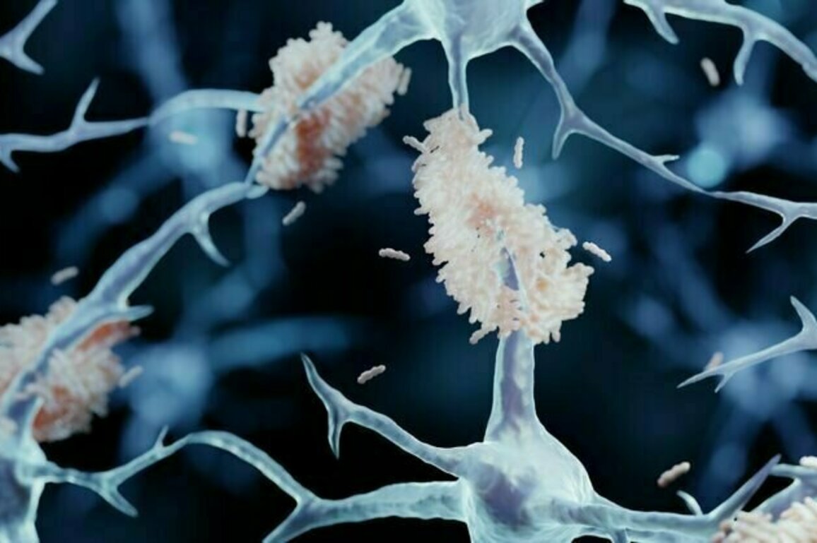 Early-onset Alzheimer's: new drug shows promise in slowing the disease