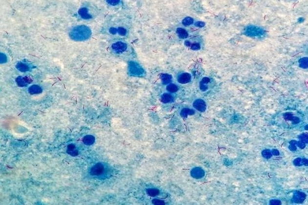 Marburg vaccine shows promising results in first-in-human study