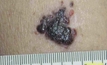 iPhone scanner detects skin cancer