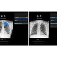 Manipal Hospitals Adopts Harrison.ai's chest X-ray AI to improve patient outcomes