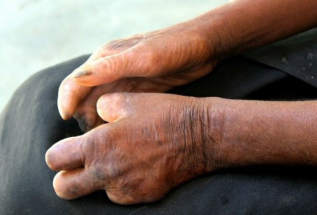 Leprosy alert in US