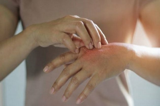 Scientists discover new drug to lower symptoms of severe eczema