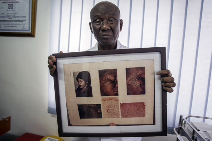 dmund elle dermatologist and founder of abito linic holds a picture of a woman with xogenous chronosis a cutaneous disorder due to a longterm application of hydroquinone skinlightening beauty products  hoto