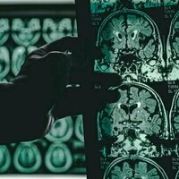 It's unlikely a magic bullet will ever cure Alzheimer's - maybe a magic shotgun can