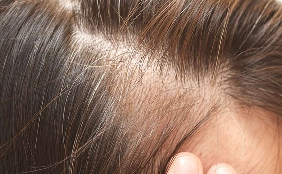 China hair transplant business files for Hong Kong IPO