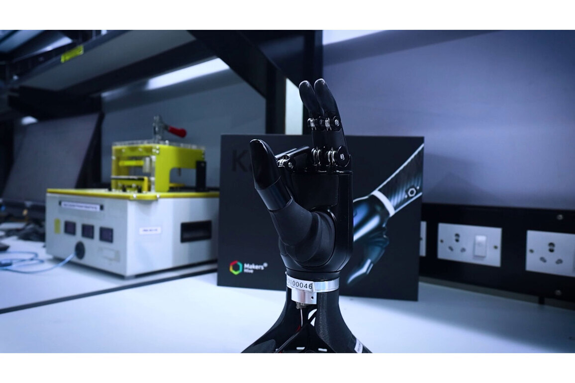Hyderabad's bionic hands: Restoring lives, rebuilding confidence
