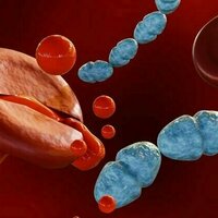Post-sepsis syndrome: when the body recovers but the brain doesn't