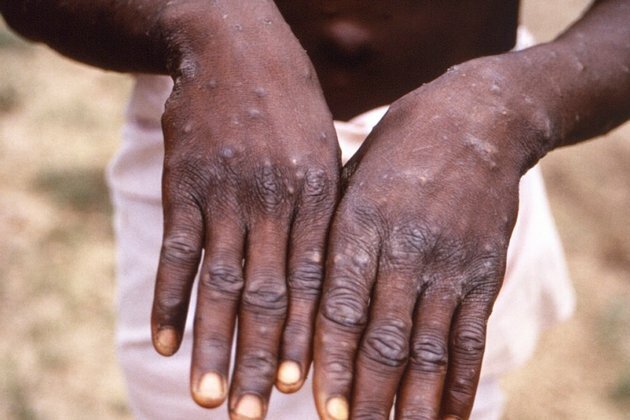 African Scientists Baffled by Monkeypox Cases in Europe, US