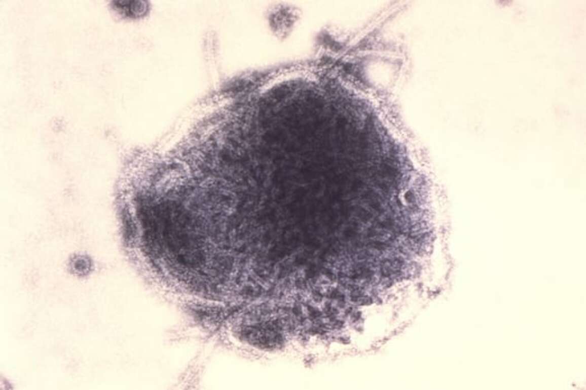 Experts urge immunization as Alberta measles count passes 300