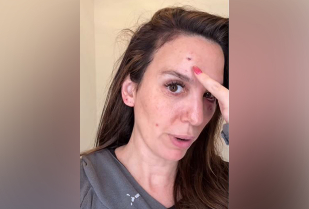 Christy Carlson Romano shares she was "shot in the eye" during husband's b'day celebration