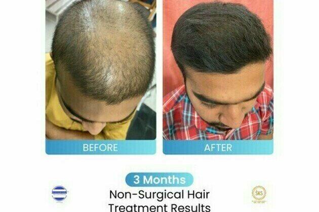 Dr Stuti Khare Shukla's Non-Surgical Hair Growth Booster helping multiple people suffering from Hair Loss Issues