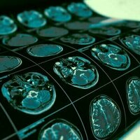 Studies of Parkinson's disease have long overlooked Pacific populations - our work shows why that must change