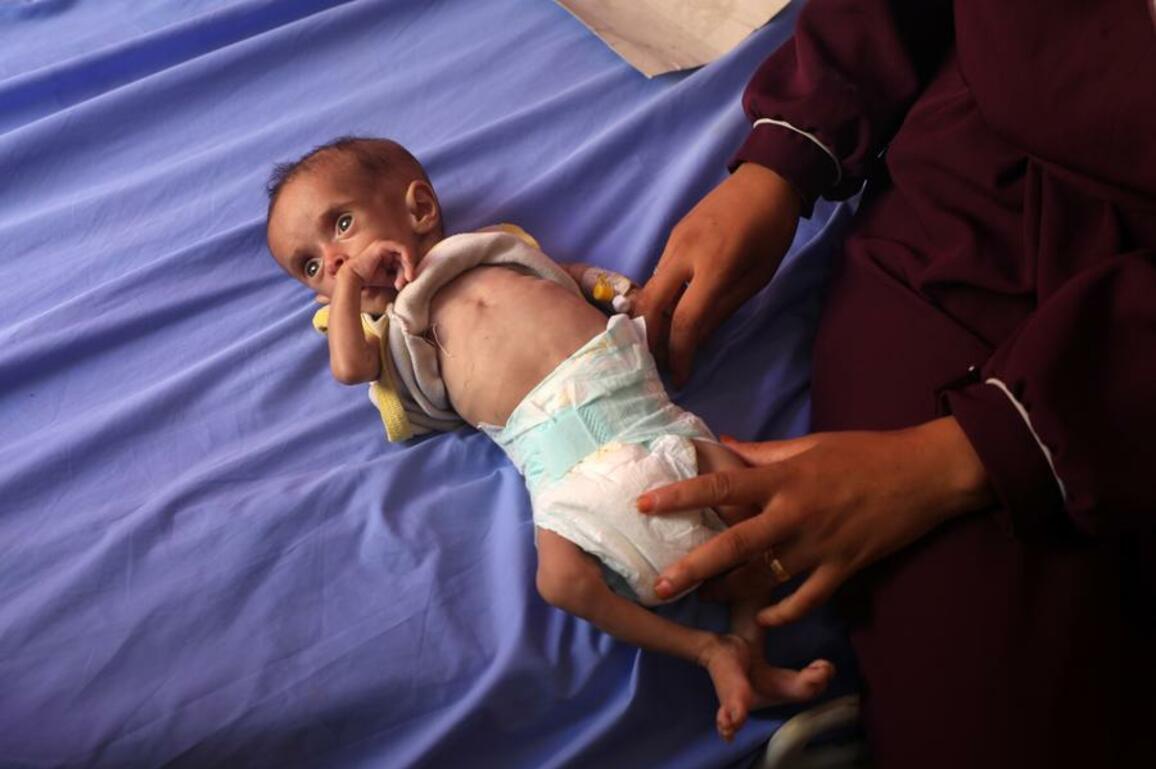 World Insights: With Gaza kids wasting away, Israeli blockade sparks global condemnation