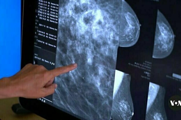 Does AI detect breast cancer better than doctors can