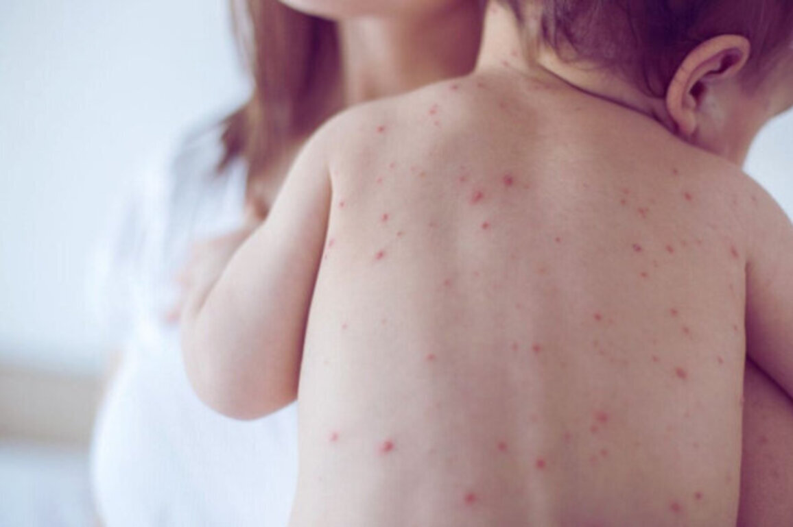 Measles Cases Rise to 66 in Bulgaria as Sofia Records First Infection
