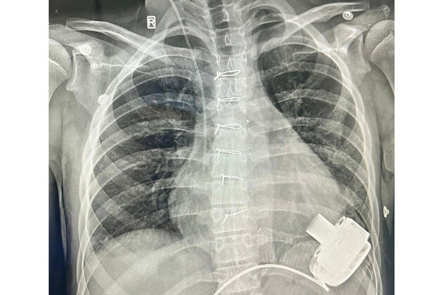 Uzbeki child with end-stage heart failure recovers after receiving mechanical heart (LVAD)