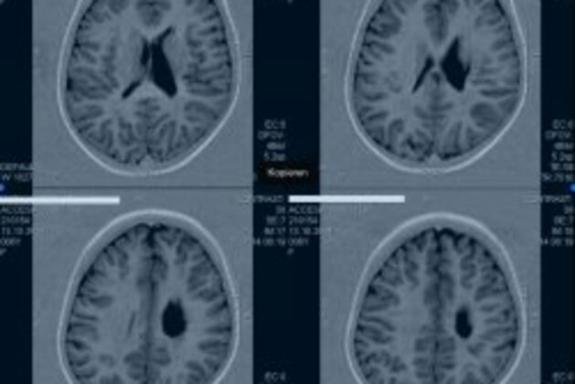 First successful treatment of traumatic paediatric stroke with autologous cord blood 