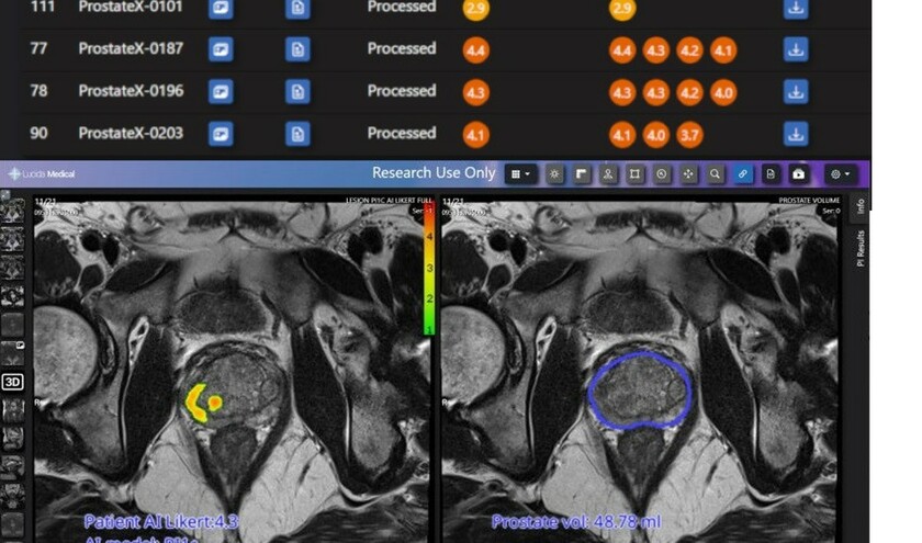 Ai tool for prostate cancer diagnosis lucida medical 840x495.jpg