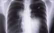 Industry endorses Qld govt 'black lung' plan