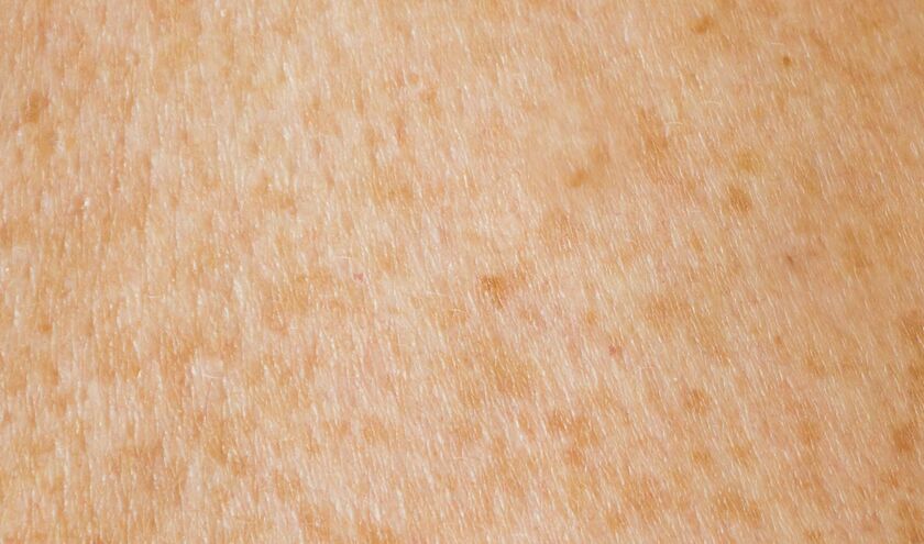 MPs launch inquiry into UV safety