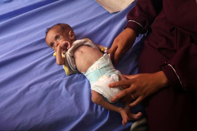 World Insights: With Gaza kids wasting away, Israeli blockade sparks global condemnation