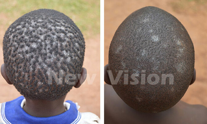 Sharing combs can result in scalp infections Sharing combs can result in scalp infections