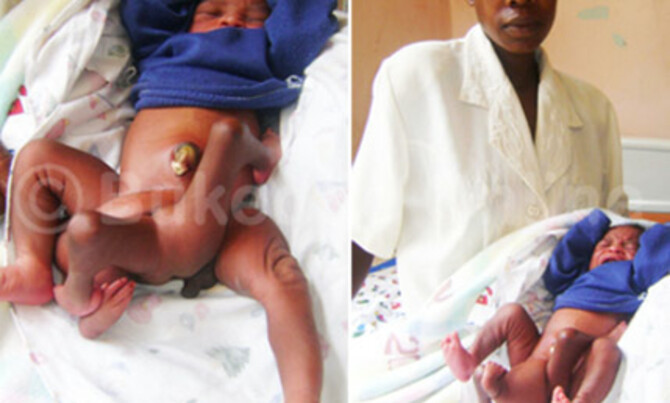 Parents shocked by child born with four extra limbs Parents shocked by child born with four extra limbs