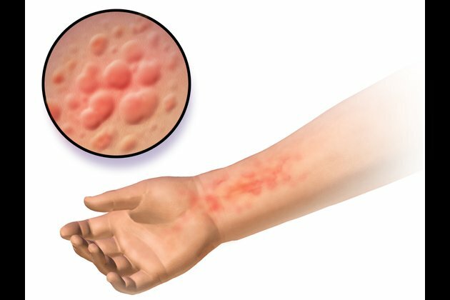 Caregivers of children with eczema suffer mild anxiety, depression