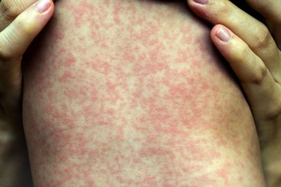 18 cases of measles reported in northern B.C., officials say