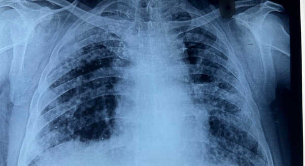 Chest X-ray of a patient diagnosed with silicosis
