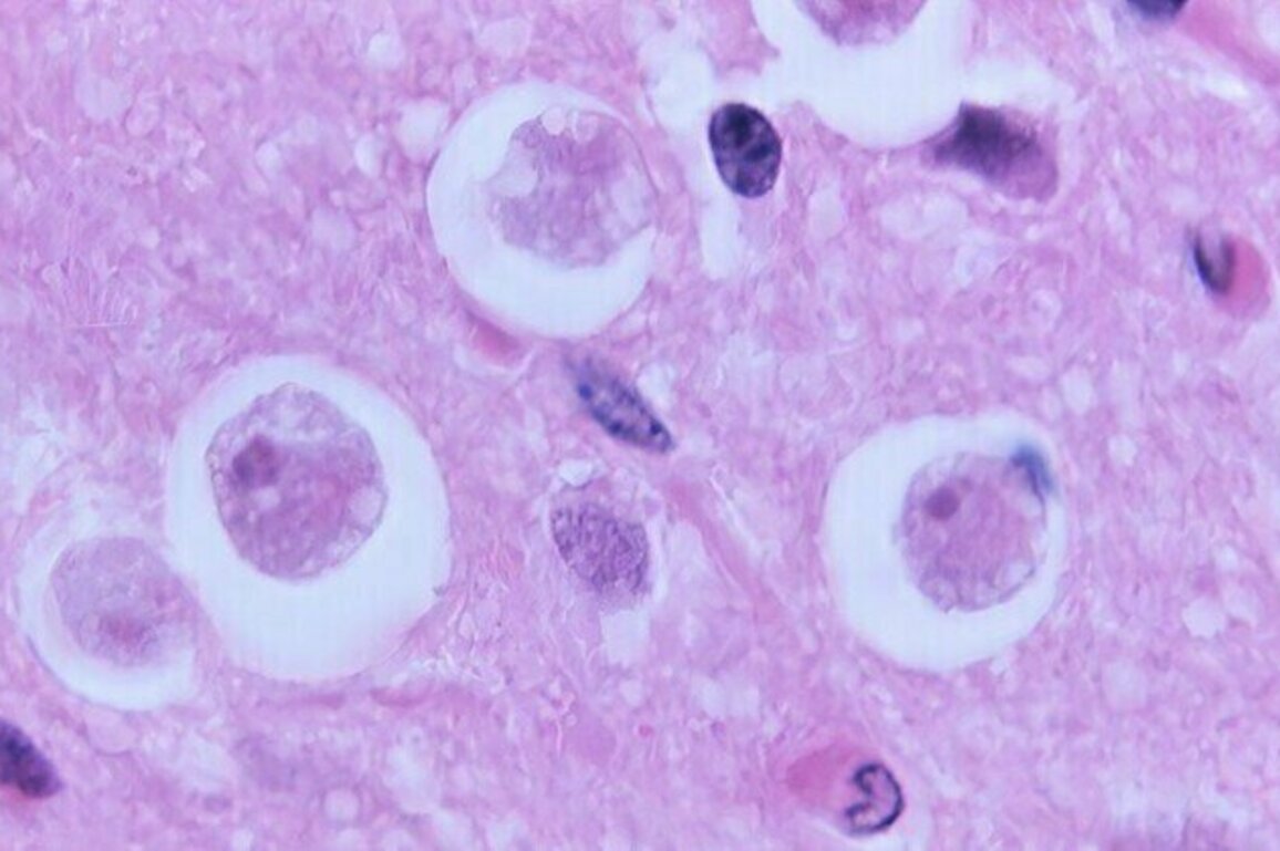 Brain-eating amoeba kills 19 in India