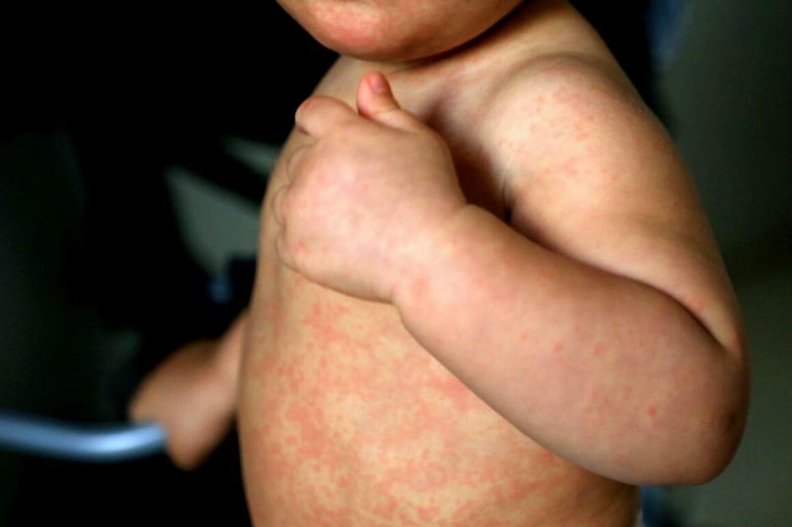 Measles cases in Glasgow's Govanhill prompt more vaccination clinics - The Herald