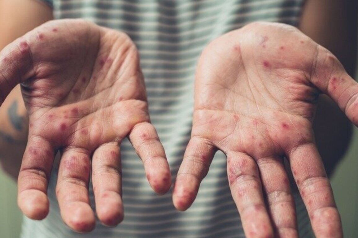 PA urged to vaccinate to prevent spread of measles this summer  